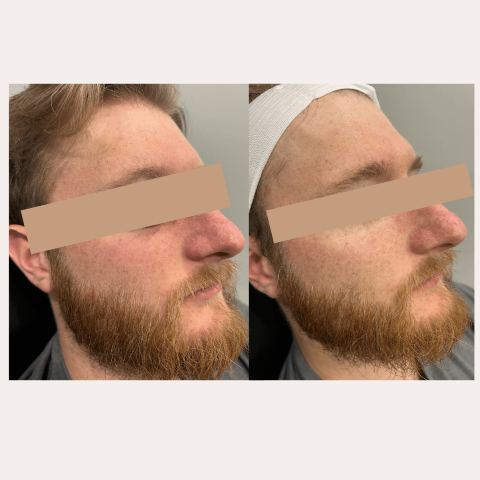 IPL Photo Rejuvenation